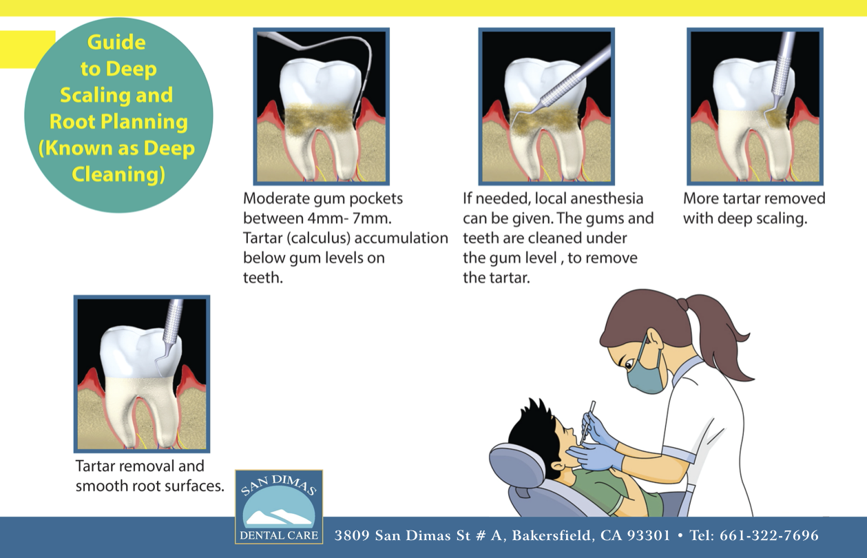 Guide to deep scaling and root planing – San Dimas Dental Care