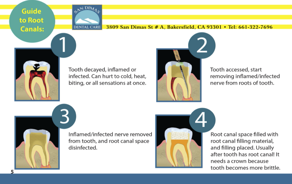 Root Canal in Bakersfield