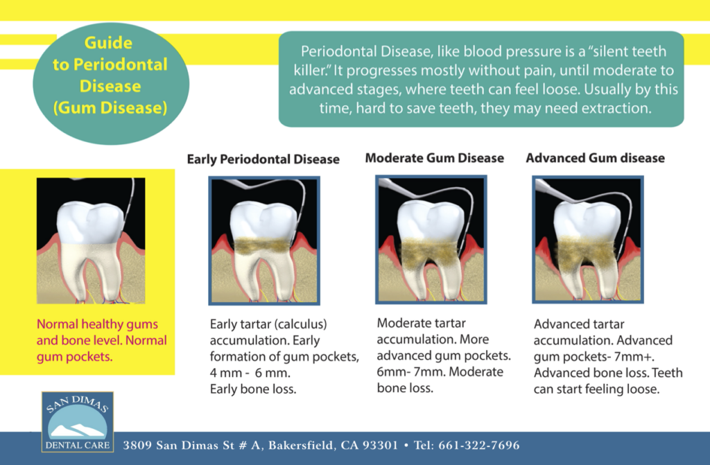 Gum Disease Treatment Bakersfield