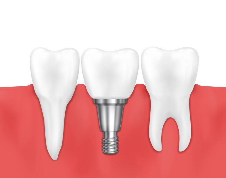 dental implant service san dimas