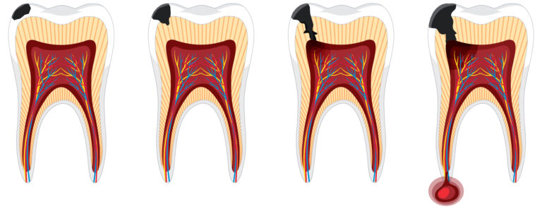 root canal in Bakersfield
