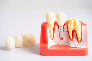 Your Frequently Asked Questions About All-on-4 Dental Implants Answered