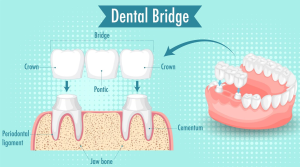 Dental Bridges vs. Dental Crowns: Which Is Right for You?